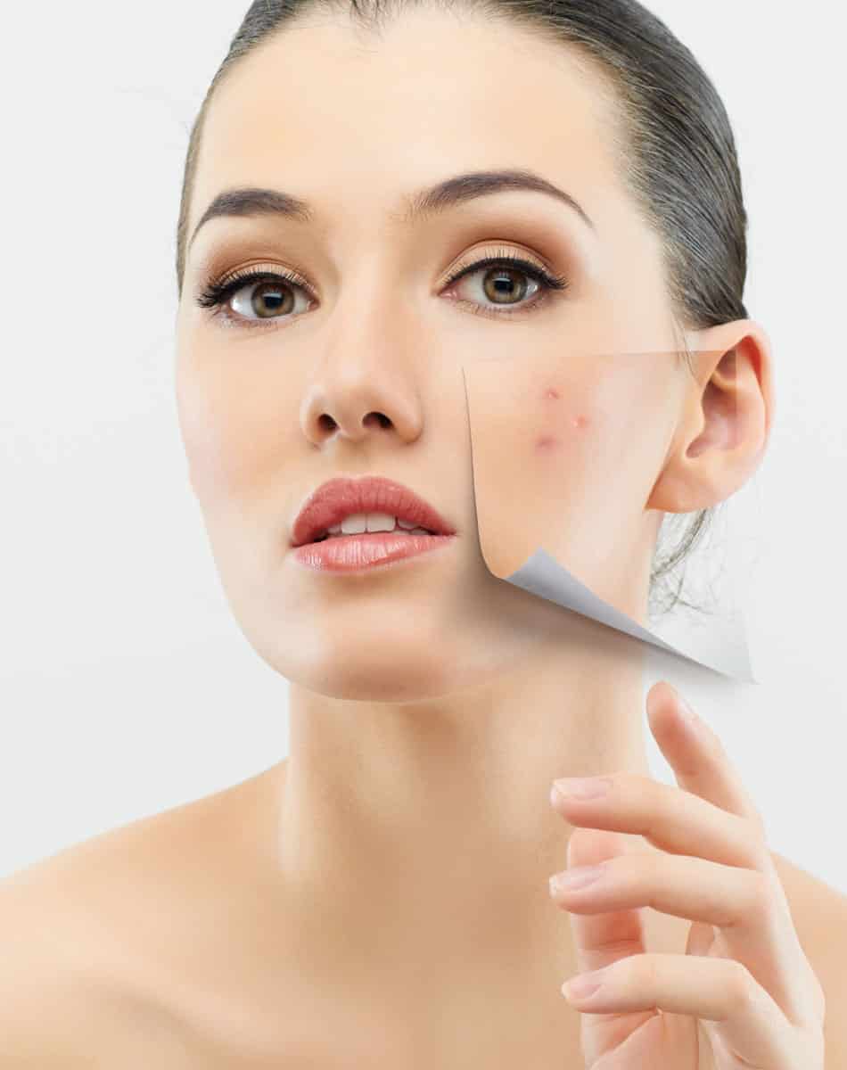 Acne Care & Patches